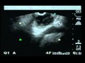 Solid Pseudopapillary Tumor - Pancreas