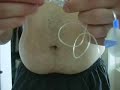 Cambio de punto de infusion en una bomba de insulina Cambio de punto de infusion en una bomba de insulina