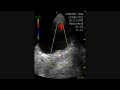 Ureteral Jet