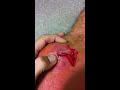 Lancing mrsa part 3