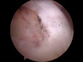 ACL surgery 2/6
