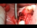 Implantes Dentales Post-Extracciones