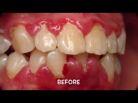 how to cure gum problems