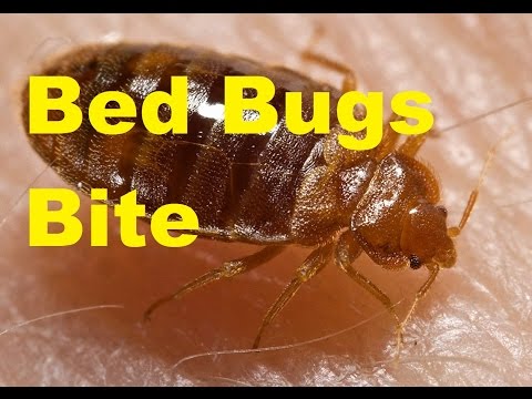 how to cure bed bug bites