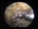 Arthroscopic rotator cuff repair ผ่าดัดส่องกล้อง เอ็นหัวไหล่