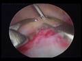 Arthroscopic rotator cuff repair ผ่าดัดส่องกล้อง เอ็นหัวไหล่
