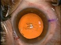 Capsulorhexis - Measurement Capsulorhexis - Measurement