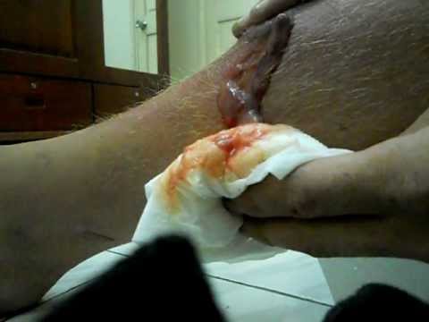 how to treat wound infection