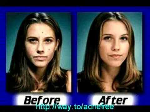 BEST ACNE CURE