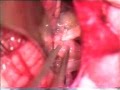 Intervention For Convulsive Spasm Of The Face