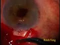 Trabeculectomy Anterior Vitrectomy Left Eye
