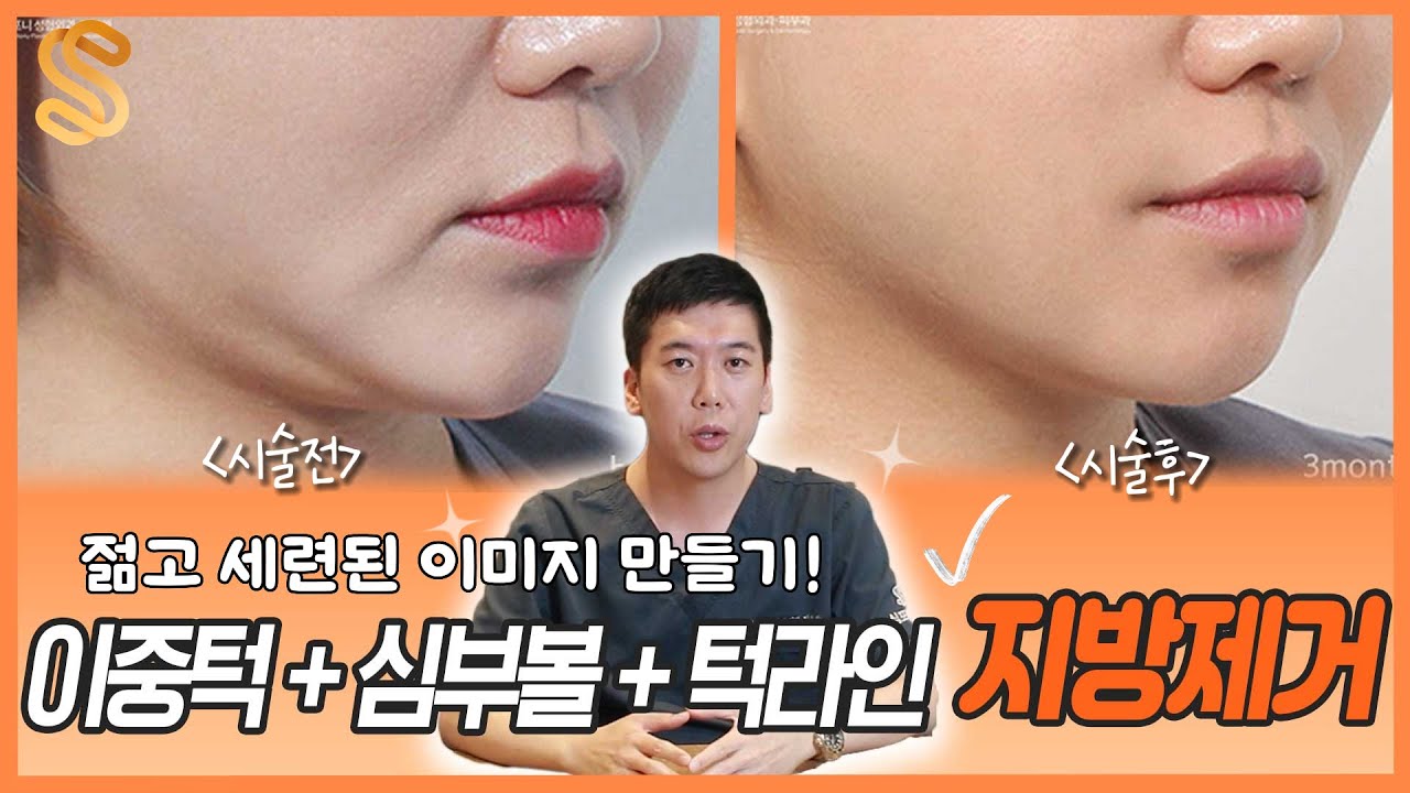 이중턱+심부볼+턱라인 지방 제거 심포니 셀아웃 주사 3인 케이스 스터디!