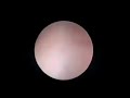 Ureteroscopy and Laser Lithotripsy
