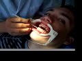 Braces in China (with Neville)
