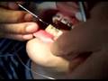 Braces in China (with Neville)