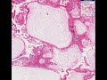 Histopathology Uterus, corpus, placenta--Hydatidiform mole Histopathology Uterus, corpus, placenta--Hydatidiform mole