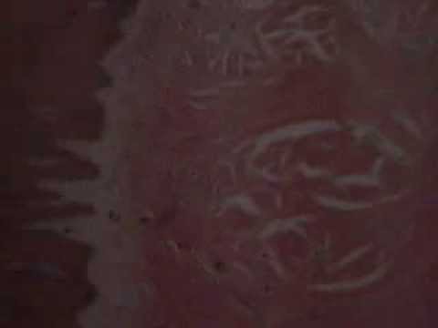 how to cure circumvallate papillae