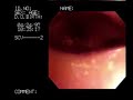 fiberoptic laryngoscopy and bronchoscopy fiberoptic laryngoscopy and bronchoscopy