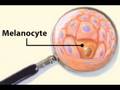Identifying Melanoma (Health Tip)