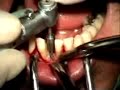 Lower incisor