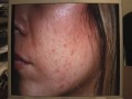 The Acne Practice (Spanish 1) The Acne Practice (Spanish 1)