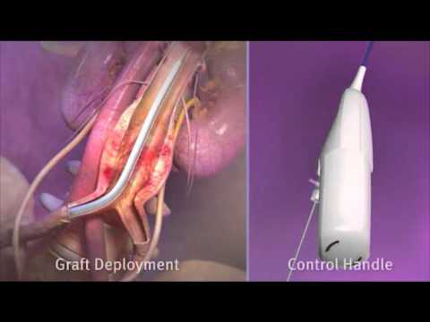 how to cure aortic aneurysm