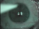 Refractive Surgery (PRK) Refractive Surgery (PRK)