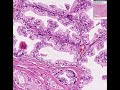 Histopathology Prostate--Adenocarcinoma Gleason (grade 1) Histopathology Prostate--Adenocarcinoma Gleason (grade 1)