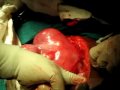 multiple fibroids