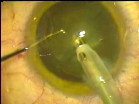 Cataract Surgery - Tip for Improved ...