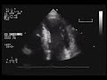 Heart UltraSound Comparison - Hypertrophic Cardiomyopathy Cardiomyopathy