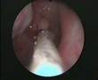 Cáncer de nasofaringe