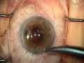 Ant. Vitrectomy & Secondary A/C IOL, Pt. 2 of 3