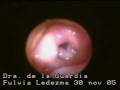 Congenital Vascular ring compresing trachea. /Compresión traqueal por anillo vascular congenito.mpg
