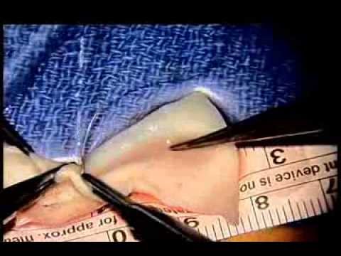 how to get an ovary transplant