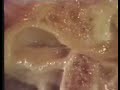 Patholgy: Ant DD no Reduction