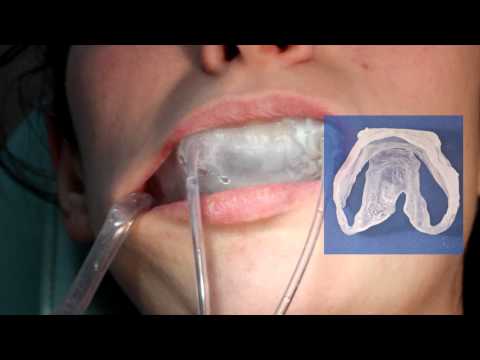 Kits domésticos de blanqueamiento dental: ¿sirven de algo?