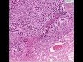 Histopathology Salivary gland--Adenoid cystic carcinoma Histopathology Salivary gland--Adenoid cystic carcinoma