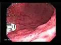 Video Endoscopy of Severe gastritis