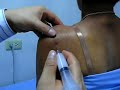 subacromion injection impingement test ???????????? ???????