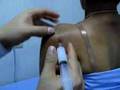 subacromion injection impingement test ฉีดยาข้อไหล่ หัวไหล่
