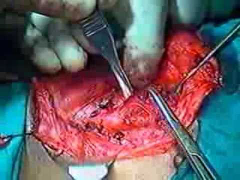 how to drain retropharyngeal abscess