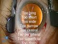 Corneal Phaco basic techniques Corneal Phaco basic techniques