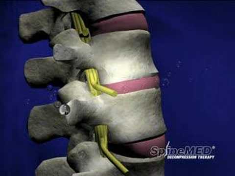 decompression - Spinal Decompression.