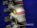 Spinal Decompression
