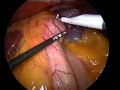 Laparoscopic Adjustable Gastric Band (Mide Kelepçesi) Laparoscopic Adjustable Gastric Band (Mide Kelepçesi)