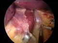 Laparoscopic Adjustable Gastric Band (Mide Kelepçesi)