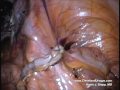 Laparoscopic Appendix Removal Using SILS/LESS/SPA Technique