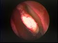 Power Assisted Anterior Turbinectomy