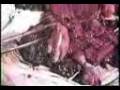 videos de aborto